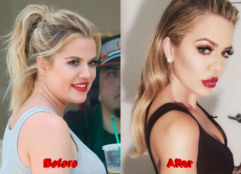 Khloe-Kardashian-Plastic-Surgery-before-after-botox