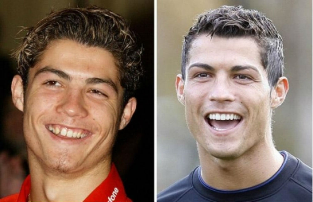 cristiano-ronaldo-teeth