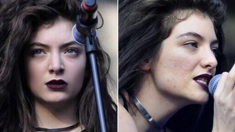 Lorde acne